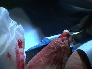 australian Vasektomie auf ungeschnitten männlich - prep, rasieren, Training Band